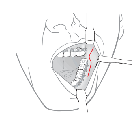 Medartis-90-graden-schroevendraaier