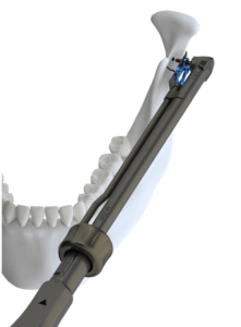 Medartis-screwdriver