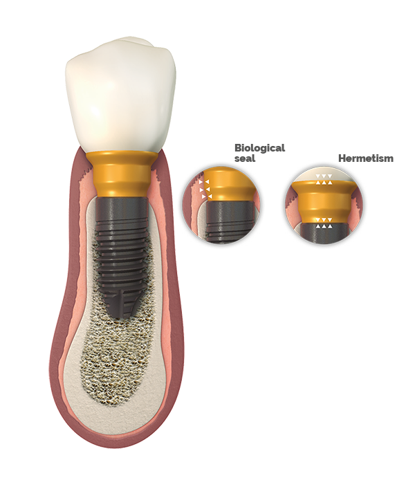 BTI-prothese-bioblock