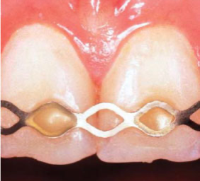 Titanium Trauma Splint 52x0.2mm