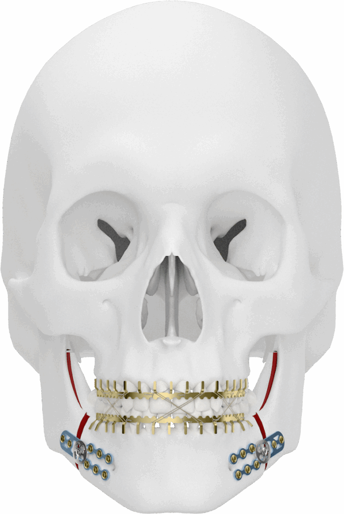 Arch Bar (winterspalk)